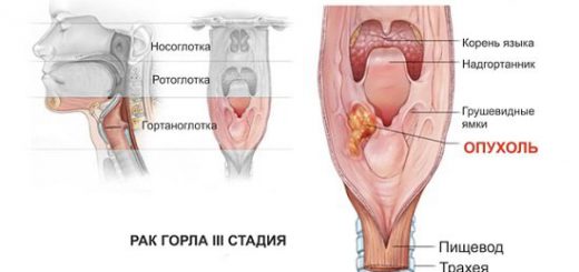 Рак горла.jpg
