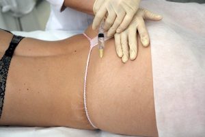 Мезотерапия при растяжках