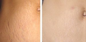 Пластическая хирургия растяжек