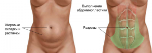 абдоминопластика проведение