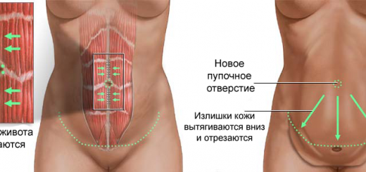 абдоминопластика живота