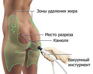 вакуумная липосакция