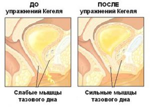 Эффективность упражнений Кегеля