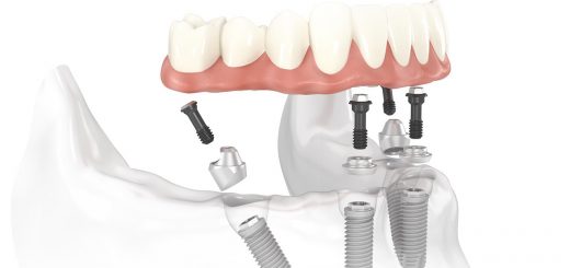 Виды и преимущества абатментов