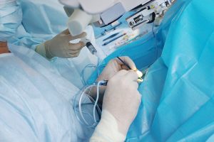 Факоэмульсификация катаракты